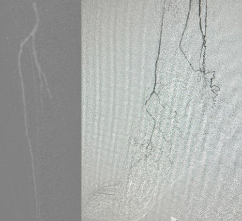 Angiography: patency of the anterior tibial, but occlusion of the dorsalis pedis; patency of peroneal; occlusion of posterior tibial