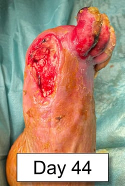 Treatment for no-option CLTI patient: Flow focalization