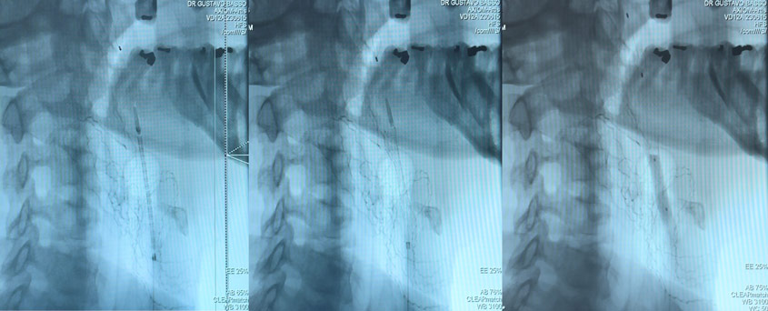 Carotid stenting treatment: pos Angiogram