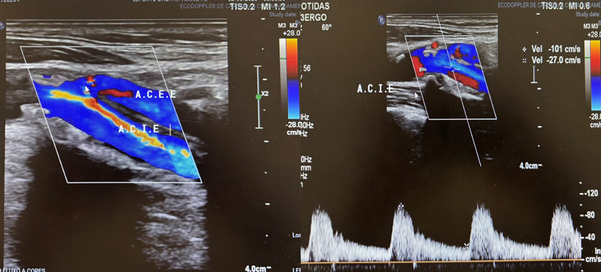 Carotid stenting treatment: 90d Dupplex control 