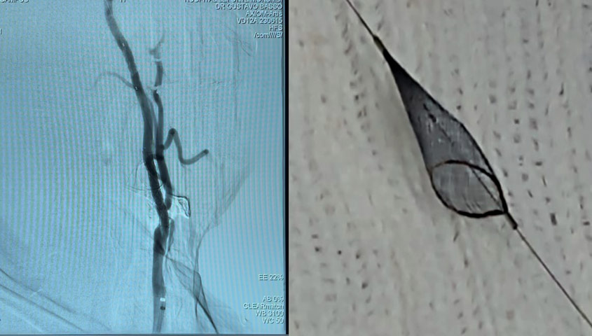 Carotid stenting treatment