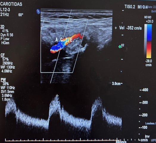 Diffuse parietal disease with left carotid stenosis > 70% with calcified ulcer