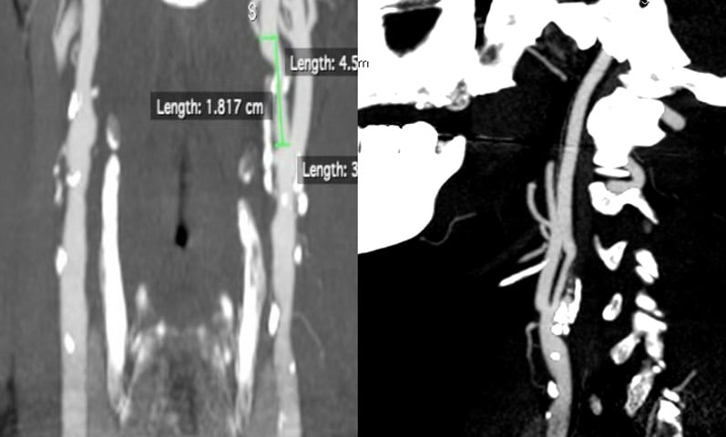Carotid treatment: AngioCT