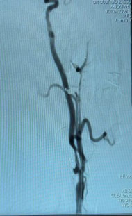 Carotid treatment: pre Angiogram