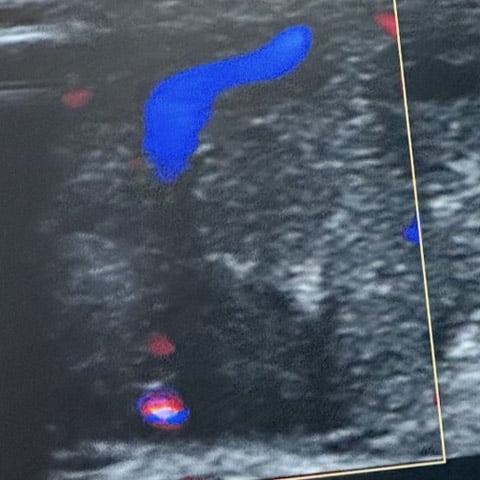 7-days old baby with AV malformation: Perfusion reduction of the tumor by angiography and duplex scan