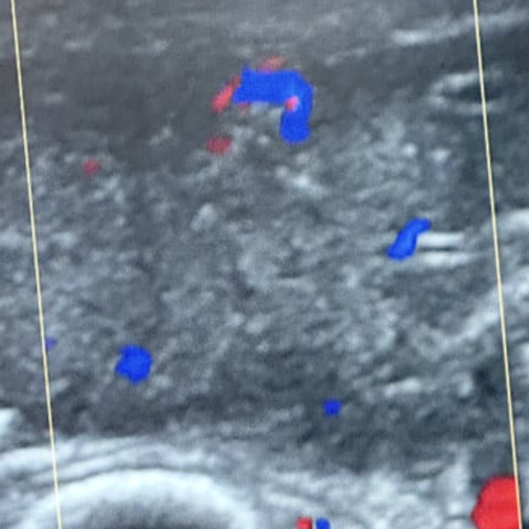 7-days old baby with AV malformation: Perfusion reduction of the tumor by angiography and duplex scan