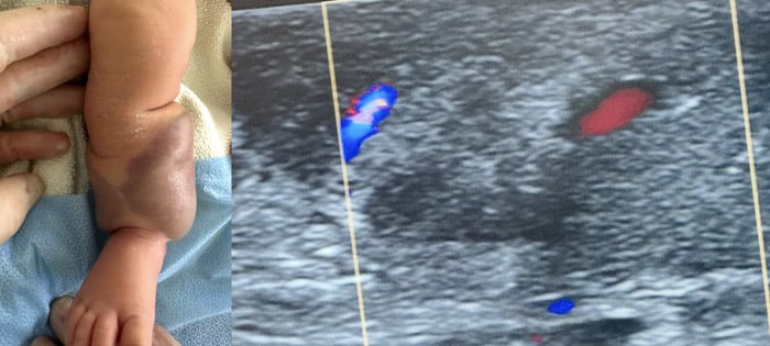 7-days old baby with AV malformation: Normal perfusion of the foot and of posterior tibial artery and vein