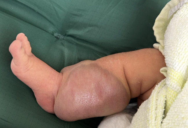7-days old baby with AV malformation: The skin surface is dark red in color. The local skin temperature is increased.