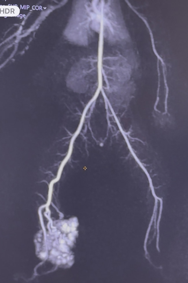 7-days old baby with AV malformation: AV malformation with multiple feeding arteries 