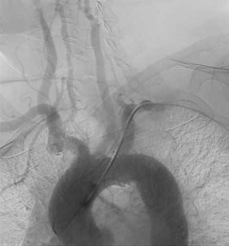 Severe CAS associated with contralateral carotid occlusion: Type 1 aortic arch