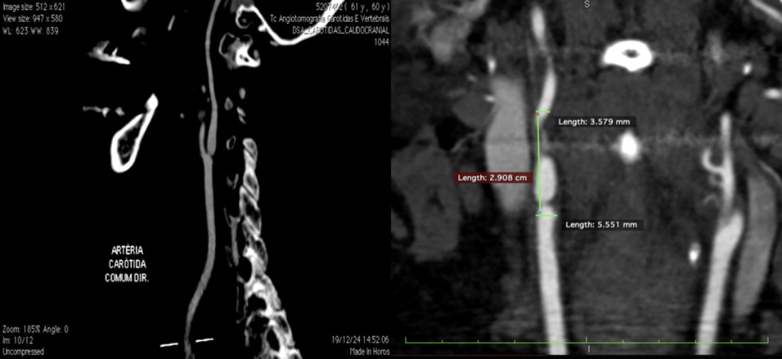 Carotid stenosis: NO atheromatous plaques