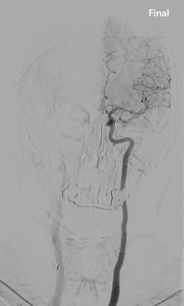 Endovascular Management of a Carotid Aneurysm