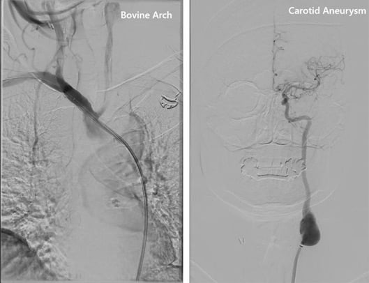 Endovascular management of a carotid aneurysm