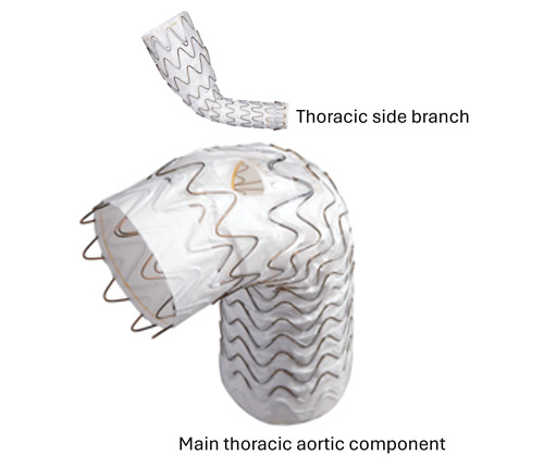Endovascular therapy of the thoracic aorta: GORE® TAG® Thoracic Branch Endoprosthesis (TBE) 