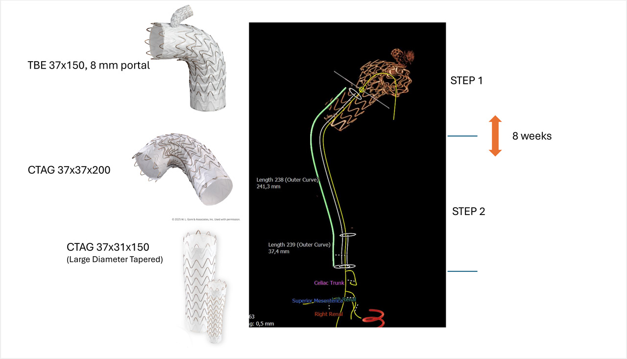 Endovascular therapy of the thoracic aorta: Staged approach for spinal cord protection