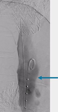 Endovascular therapy of the thoracic aorta