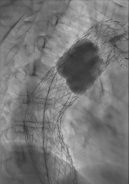 Ballooning under controlled hypotension with a Tri-Lobe balloon