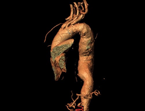 Endovascular therapy of the thoracic aorta: Length & Extent 