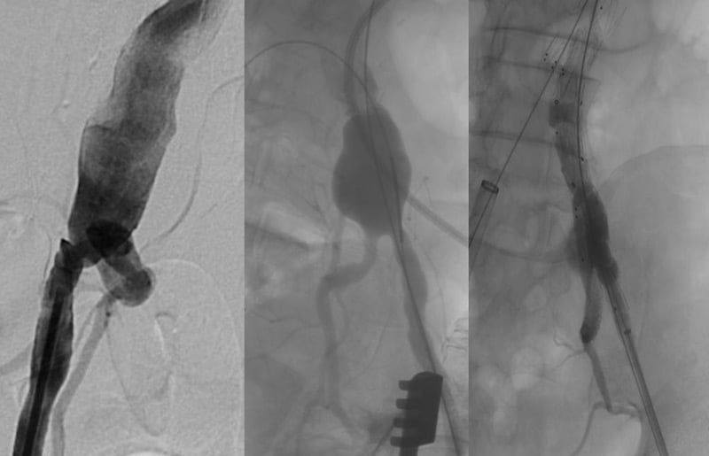 STEP 3:  Bilateral Iliac Branch, Right and left illiac bifurcation