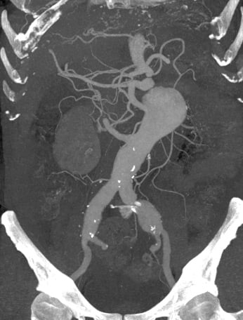 STEP 3:  Bilateral Iliac Branch
