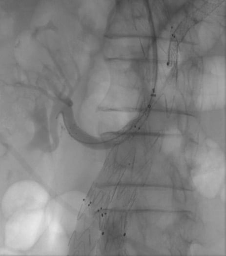 Right renal artery