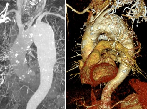 Anatomically challenging aortic arch aneurysm