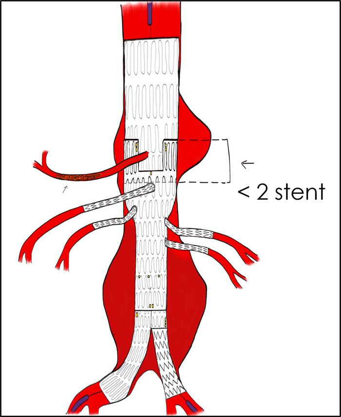 Coeliac Pseudo aneurysm treatment in emergency - Figure 2