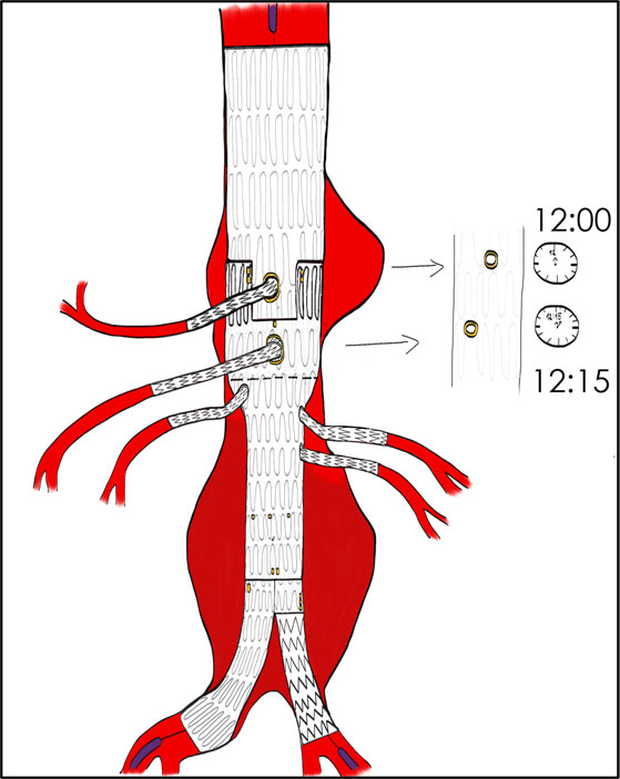 Coeliac Pseudo aneurysm treatment in emergency - Figure 3