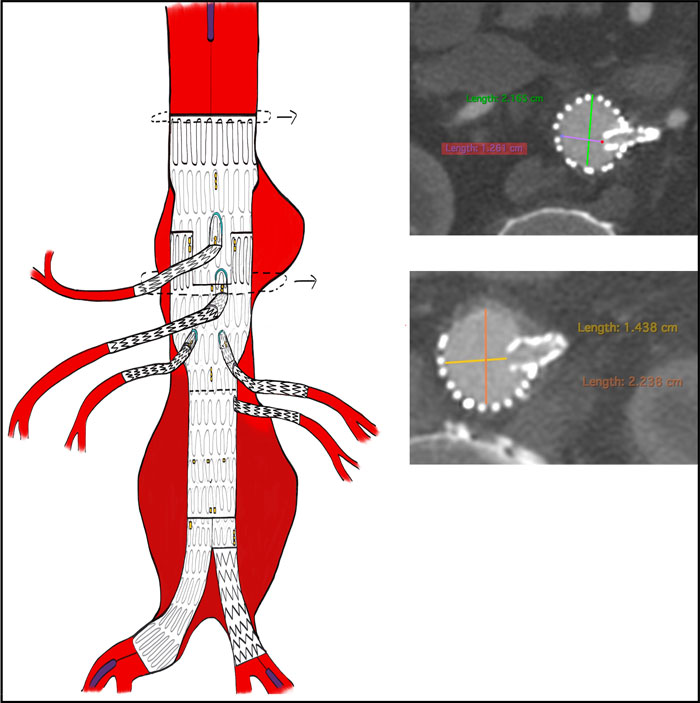 Coeliac Pseudo aneurysm treatment in emergency - Figure 4