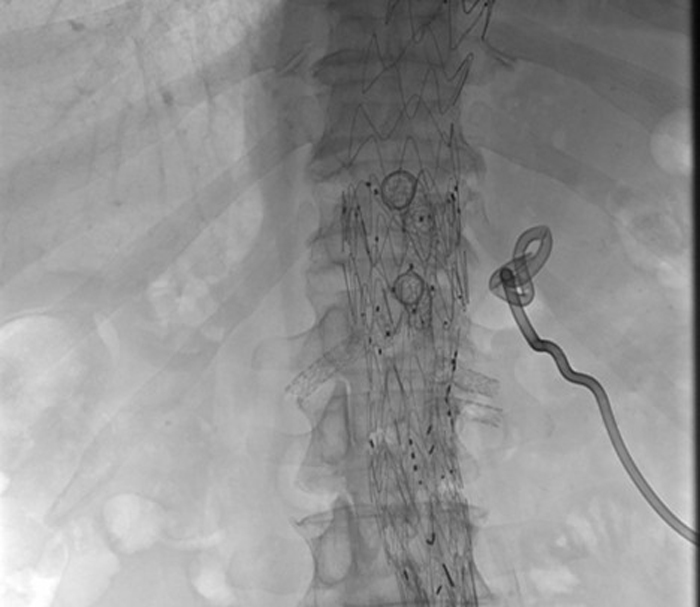 Coeliac Pseudo aneurysm treatment in emergency - Figure 6