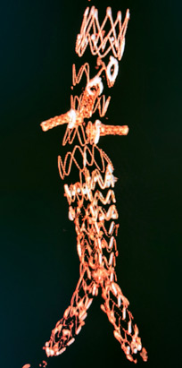 AngioTC postop