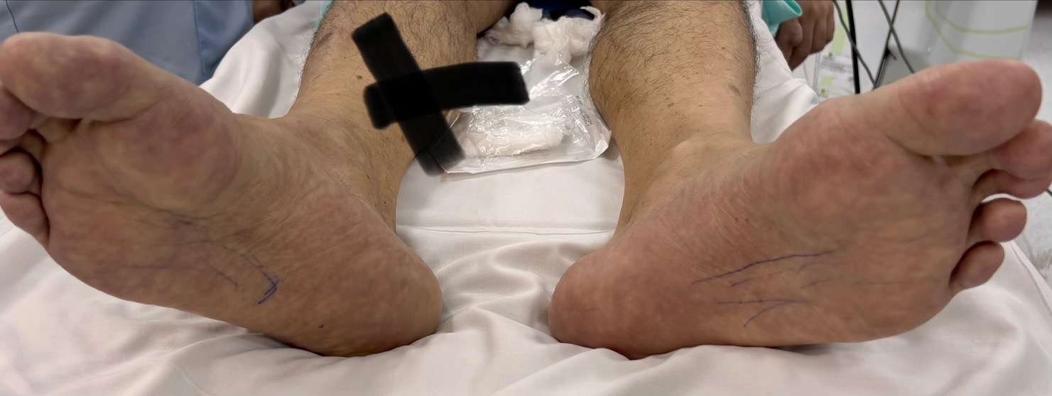 Acute limb ischemia: CFA occlusion