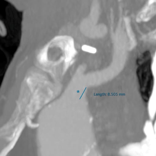 Anatomically challenging aortic arch aneurysm: Short brachiocephalic trunk (<1cm) 