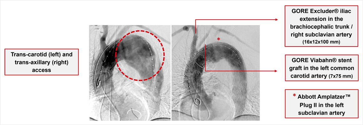 Branched TEVAR with Custom-Made Terumo Relay® Double Inner-Branched Endograft (46x32x270 mm)