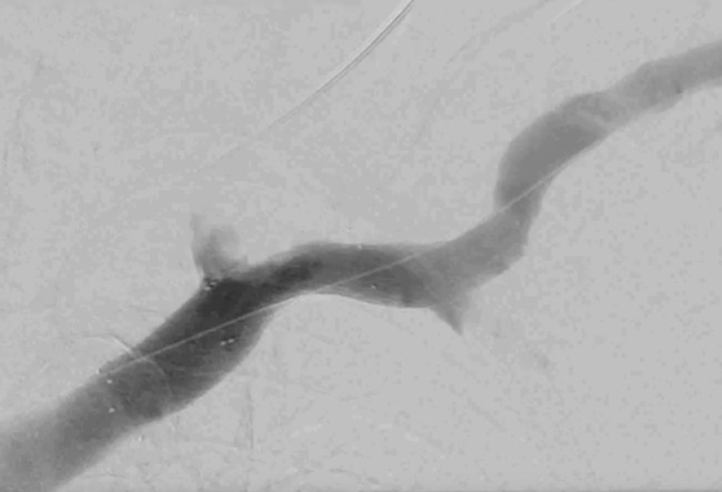 Phlebography shows complete occlusion of the brachiocephalic vein