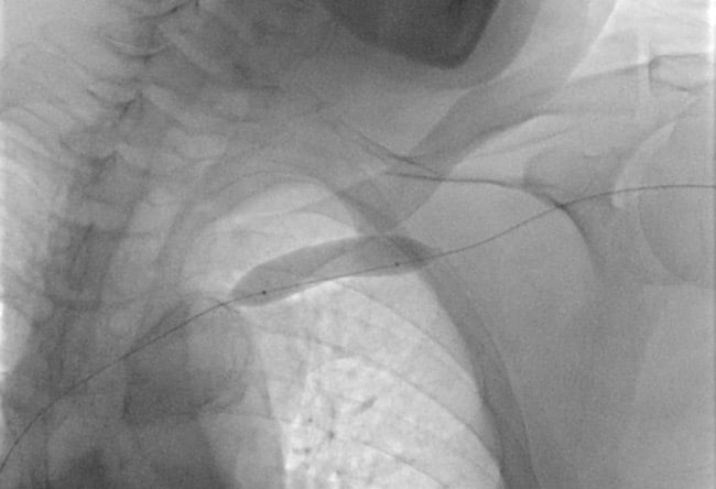 Angioplasty of subclavian vein stenosis