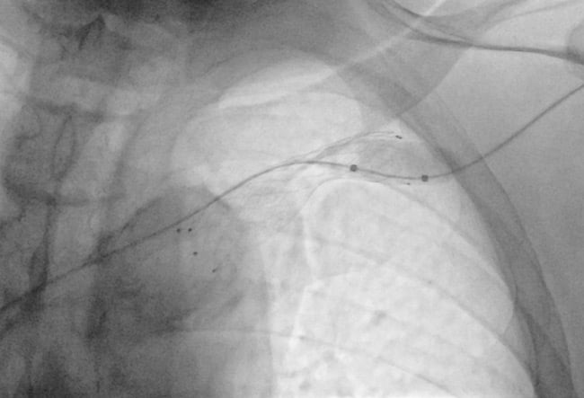Stenting of subclavian vein re-stenosis