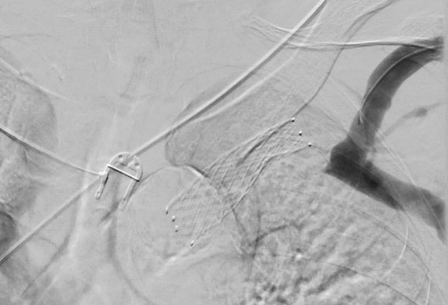 Phlebography, showing stent occlusion and misplacement 