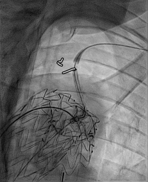 Endovascular therapy of the thoracic aorta: Challenging branch take-offs may require specific angulations!