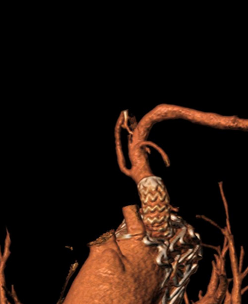 Endovascular therapy of the thoracic aorta: Challenging branch take-offs may require specific angulations!