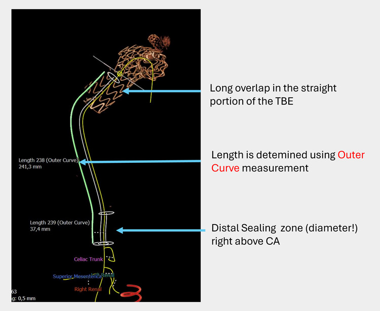 Endovascular therapy of the thoracic aorta: Step 2 (after 8 weeks):