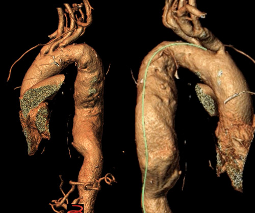Endovascular therapy of the thoracic aorta: Proximal sealing concept