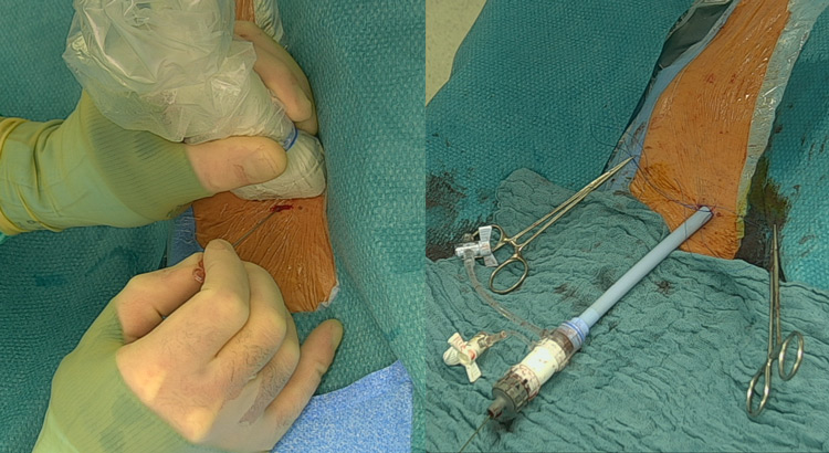 Endovascular therapy of the thoracic aorta: GORE® TAG® Thoracic Branch Endoprosthesis (TBE) 