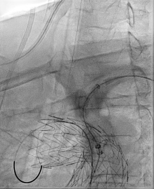 Endovascular therapy of the thoracic aorta: Challenging branch take-offs may require specific angulations!