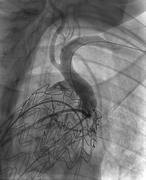 Endovascular therapy of the thoracic aorta: Challenging branch take-offs may require specific angulations!