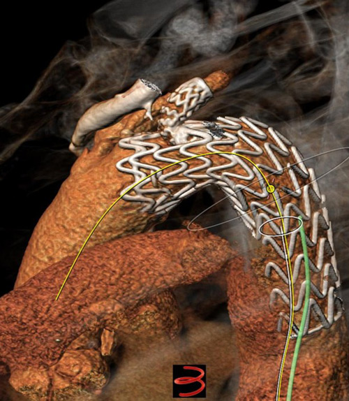 Endovascular therapy of the thoracic aorta: Step 1: Result