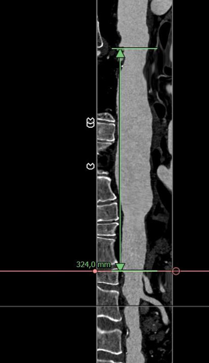 Endovascular therapy of the thoracic aorta: Staged approach for spinal cord protection