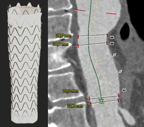 Endovascular therapy of the thoracic aorta: Distal optimisation and future treatment option