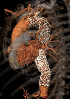 Endovascular therapy of the thoracic aorta: Staged deployment of the tapered CTAG with precise control of the distal landing zon