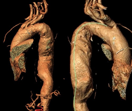 Endovascular therapy of the thoracic aorta: Progressive Aneurysm, Diameter 58mm